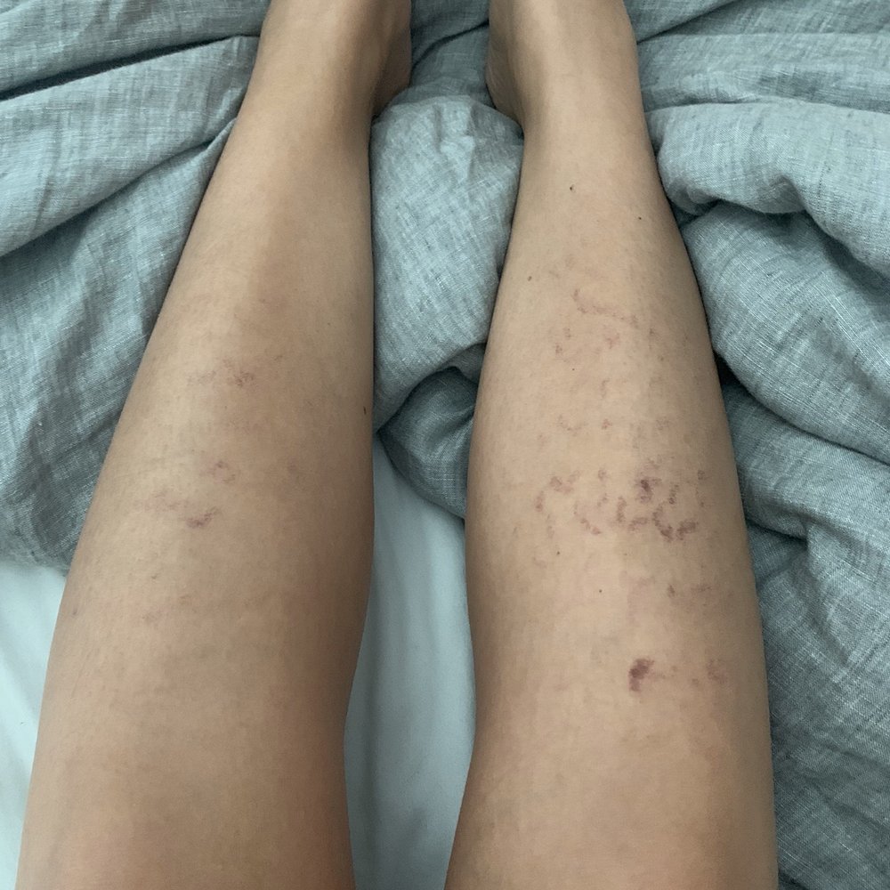 Ideal Image Tampa - Day after treatment. - Laser Hair Removal Near Me - Tampa, Florida