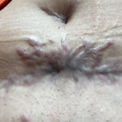 Arrowhead Plastic Surgeons - Post tummy tuck Dr. Kesler. Not even a refund after spending $16k to look like this.