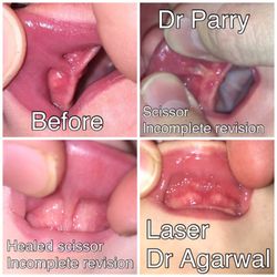 Tucson ENT - I will never recommend Dr Parry for a lip or tongue tie revision. I've meet many parents online who have had similar experiences.