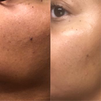 GetSnatched - Before and after facial treatment! - Waxing Near Me - South Plainfield, New Jersey