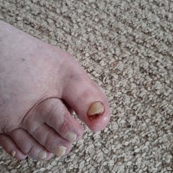 East Village Foot & Ankle Surgeons - Sorry for the graphic image, but the podiatrist " Dr. Raatz" mangled my mothers toe nail.