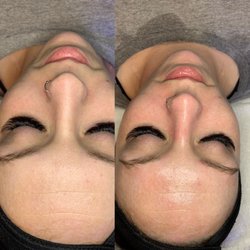 Essence Day Spa - Before and after of our HydraFacial Treatment with a fresh set of Volume lash extensions.