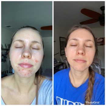 Honeys Skincare - After first facial -- 3 months later after consistent visits! - Skin Care Near Me - Riverside, California