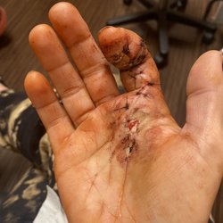 Arizona State Orthopaedics - Immediately post op.