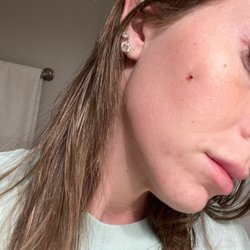 Emergency Room at Arizona General Hospital - Mesa, AZ - First bite which started to deteriorate my skin