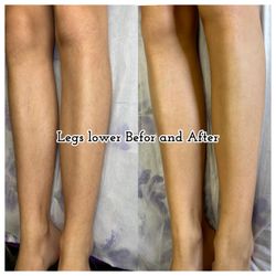 Beauty Pro By Jane - Lower legs Before and After