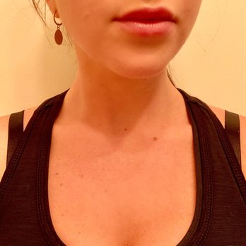 Alchemy 43 - Flatiron - 1/2 CC of Juverderm Ultra. Amazingly natural results. - Medical Spas Near Me - New York, New York