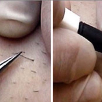 Body Care Med Spa - Electrolysis the only FDA approved permanent hair removal method - Permanent Makeup Near Me - Lake Worth, Florida Body Care Med Spa - Electrolysis the only FDA approved permanent hair removal method - Permanent Makeup Near Me - Lake Worth, Florida