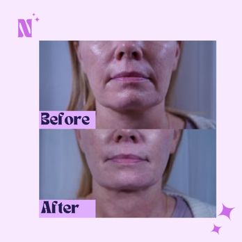 Enhanced by Nadia - This beauty wanted to lift her jawline! Results after only one Ultherapy treatment! - Aestheticians Near Me - Los Angeles, California Enhanced by Nadia - This beauty wanted to lift her jawline! Results after only one Ultherapy treatment! - Aestheticians Near Me - Los Angeles, California