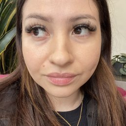 Before filler under my eyes about half syringe Before filler under my eyes about half syringe