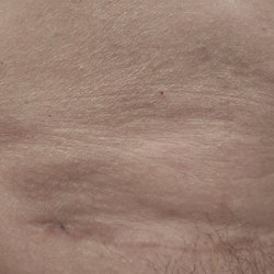 Adam J Rubinstein, MD FACS - Lower Abdominal liposuction post surgery 8 months not smooth, uneven, divots, unsightly