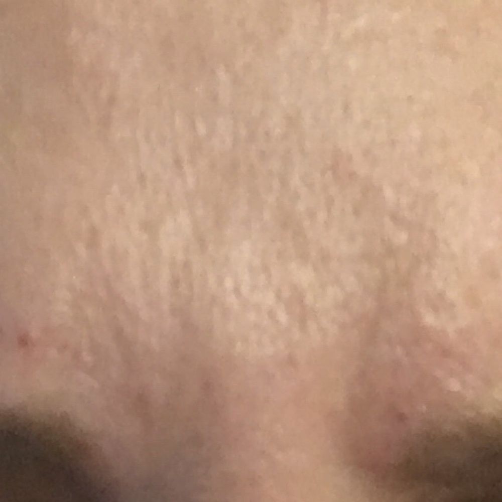 Nicole Carnicella DMD MAGD - After Botox furrowing my brows - General Dentistry Near Me - Bellefonte, Pennsylvania