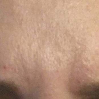 Nicole Carnicella DMD MAGD - After Botox furrowing my brows - General Dentistry Near Me - Bellefonte, Pennsylvania Nicole Carnicella DMD MAGD - After Botox furrowing my brows - General Dentistry Near Me - Bellefonte, Pennsylvania