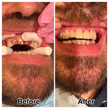 Amazing Smiles - Leibowitz and Cinquemani DDS - A very happy patient with his new (bridge) & now has an Amazing Smile! Schedule your consultation today! - General Dentistry Near Me - Elmhurst, New York Amazing Smiles - Leibowitz and Cinquemani DDS - A very happy patient with his new (bridge) & now has an Amazing Smile! Schedule your consultation today! - General Dentistry Near Me - Elmhurst, New York