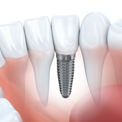 West Periodontics - Dental Implants can be life changing! Call our office for more information on how we can help you achieve that smile you have always wanted!