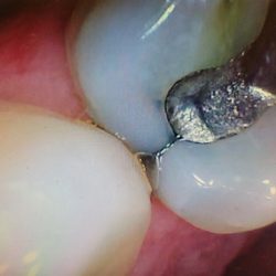 A tooth with large hairline cracks needing a crown