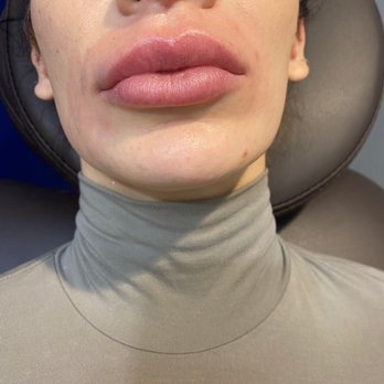 Old Town MedSpa - Lincoln Park - before first dissolving session. very uneven, overblown, big shelf. Filler around mouth changing proportions and giving "monkey" face effect - Medical Spas Near Me - Chicago, Illinois Old Town MedSpa - Lincoln Park - before first dissolving session. very uneven, overblown, big shelf. Filler around mouth changing proportions and giving "monkey" face effect - Medical Spas Near Me - Chicago, Illinois