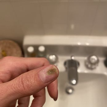 The Beauty Lounge - "Greenie" bacterial infection likely from dirty instruments at prior appointment. - Nail Salons Near Me - San Francisco, California The Beauty Lounge - "Greenie" bacterial infection likely from dirty instruments at prior appointment. - Nail Salons Near Me - San Francisco, California