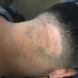 Epiphany Dermatology - Before: I had a growing spot of hairloss