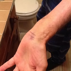 John Diana, MD - Fractured wrist being treated by Dr. Birkbeck