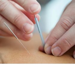 Naperville Acupuncture Center - Acupuncture