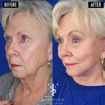 Tamplen Plastic Surgery - 3 Months after brow lift upper Blepharoplasty and Facelift. Refreshed and elegant! - Plastic Surgeons Near Me - Orinda, California Tamplen Plastic Surgery - 3 Months after brow lift upper Blepharoplasty and Facelift. Refreshed and elegant! - Plastic Surgeons Near Me - Orinda, California