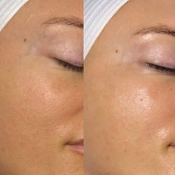 Bisous Esthetics - Pdrn infusion korean facial near east austin