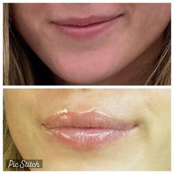 SC Injections