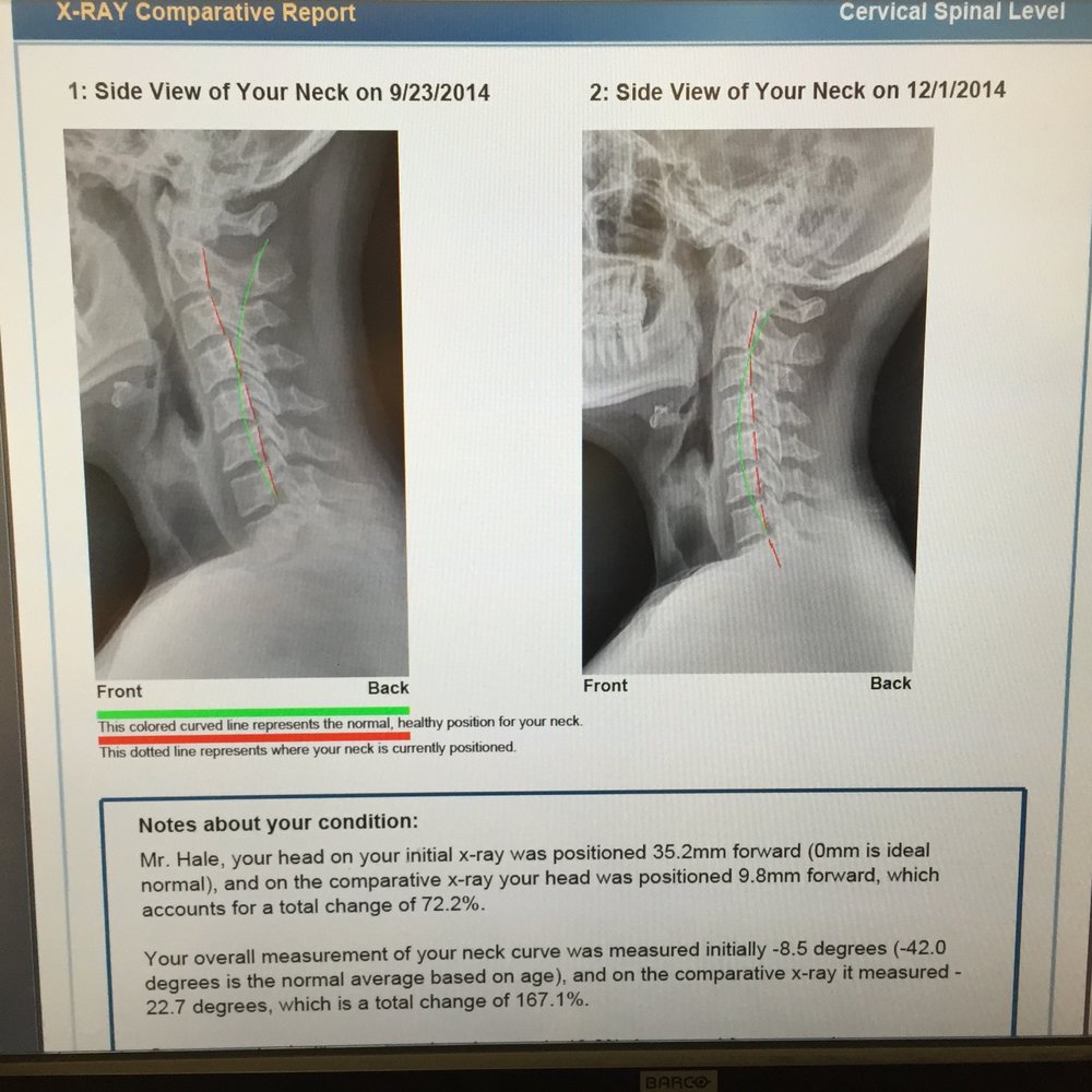 Backbone Wellness Institute, LLC - Left side: Initial visit
Right side: After 24 visits
Both photos are of me standing up straight. - Chiropractors Near Me - Cincinnati, Ohio