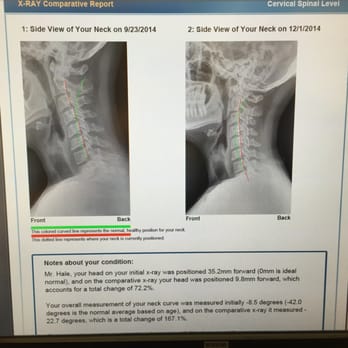 Backbone Wellness Institute, LLC - Left side: Initial visit
Right side: After 24 visits
Both photos are of me standing up straight. - Chiropractors Near Me - Cincinnati, Ohio