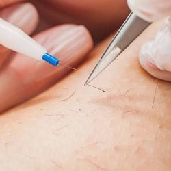 Advanced Electrology Clinic - Say goodbye to unwanted hair for good.