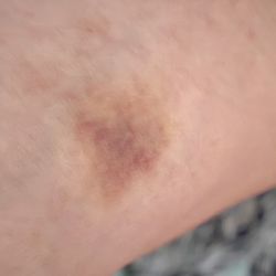 Old West End Community Health Center - Blood draw on 10-13-25 with OWECHC lab. 10-22-25 picture.