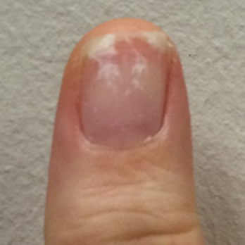 Top Solar Nails - My thumb nail after my shellac was hastily removed. All my nails look like this now. Sad. - Nail Salons Near Me - Tualatin, Oregon Top Solar Nails - My thumb nail after my shellac was hastily removed. All my nails look like this now. Sad. - Nail Salons Near Me - Tualatin, Oregon