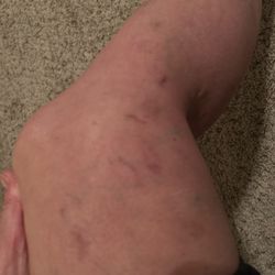 Paz Dermatology - Veins treated at Paz dermatology and new ones caused by the treatment.