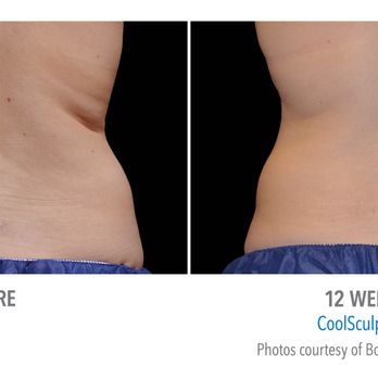 Aloha Nani Kino Spa - Coolsculpting on flank - Medical Spas Near Me Aloha Nani Kino Spa - Coolsculpting on flank - Medical Spas Near Me