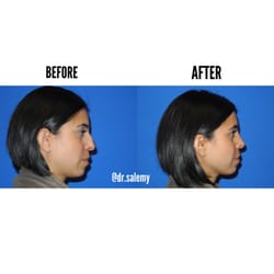 Shahram Salemy, MD - Before and 6 weeks After Rhinoplasty