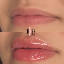 Luxsy Xthetics - Hyaluron Pen Lip Filler