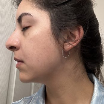 Skin By Nayra G - After - Skin Care Near Me - Downey, California Skin By Nayra G - After - Skin Care Near Me - Downey, California