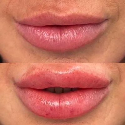 Injectables - At SKINJA medspa we offer different forms of injectables such as Botox, and lip filler Injectables - At SKINJA medspa we offer different forms of injectables such as Botox, and lip filler