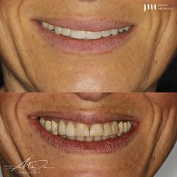 Jin Dental Aesthetics - Porcelain veneers smile make over