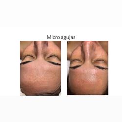 Mercedes Alizo Skin Care - Micro agujas