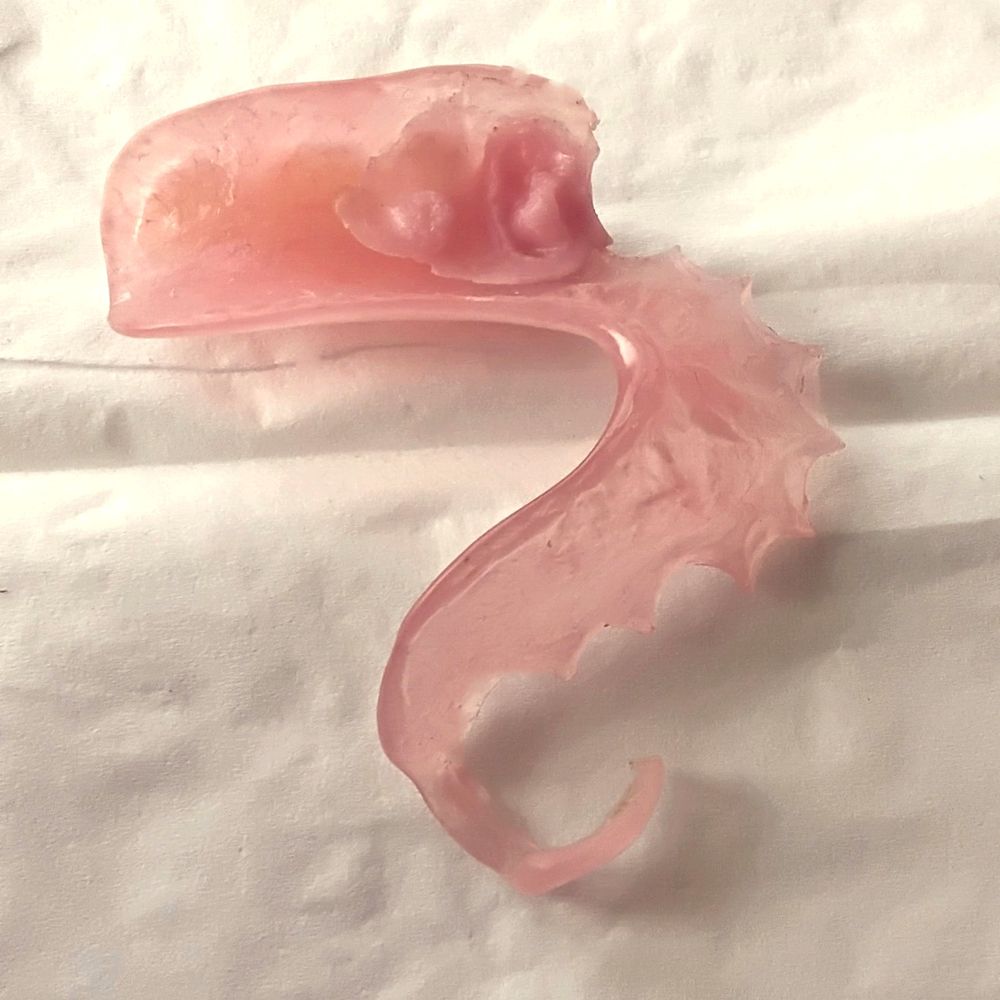 Deepak Sachdev, DDS - My denture was not a custom fit. It was oversized, floppy and therefore would not stay in. - General Dentistry Near Me - San Mateo, California Deepak Sachdev, DDS - My denture was not a custom fit. It was oversized, floppy and therefore would not stay in. - General Dentistry Near Me - San Mateo, California