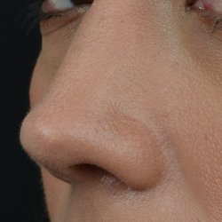 Aaron Kosins, MD - Refined and natural rhinoplasty result showing great definition and no signs of surgery at close inspection.