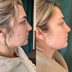 Ageless Health - Acne scarring improvement