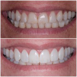 Cherrywood Dental Care - New smile after Invisalign and dental bonding to correct the bite, and allow for improved esthetics and function.