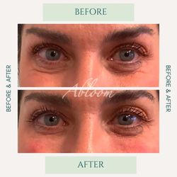 Abloom Med Spa - Under Eye filler