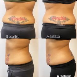 Janie’s Body Sculpting - Let me help you get rid of the stubborn back fat underneath the bra