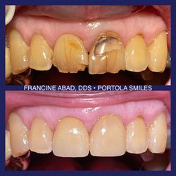 Portola Smiles - What a difference two crowns can make