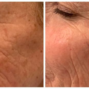 Spa Collierville & Medical Aesthetics - We'll make a plan to make those deep creases, sunspots, and wrinkles soften and fade. - Medical Spas Near Me - Collierville, Tennessee Spa Collierville & Medical Aesthetics - We'll make a plan to make those deep creases, sunspots, and wrinkles soften and fade. - Medical Spas Near Me - Collierville, Tennessee