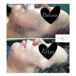Clean Slate Waxing Lounge - Chemical Peel Series